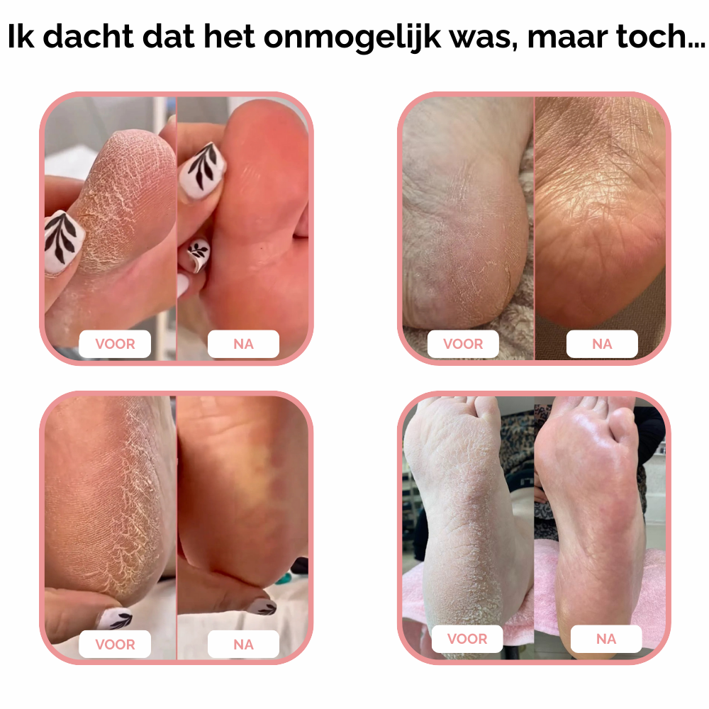 PediLume™ Pro - Verwijder Eelt Voorgoed